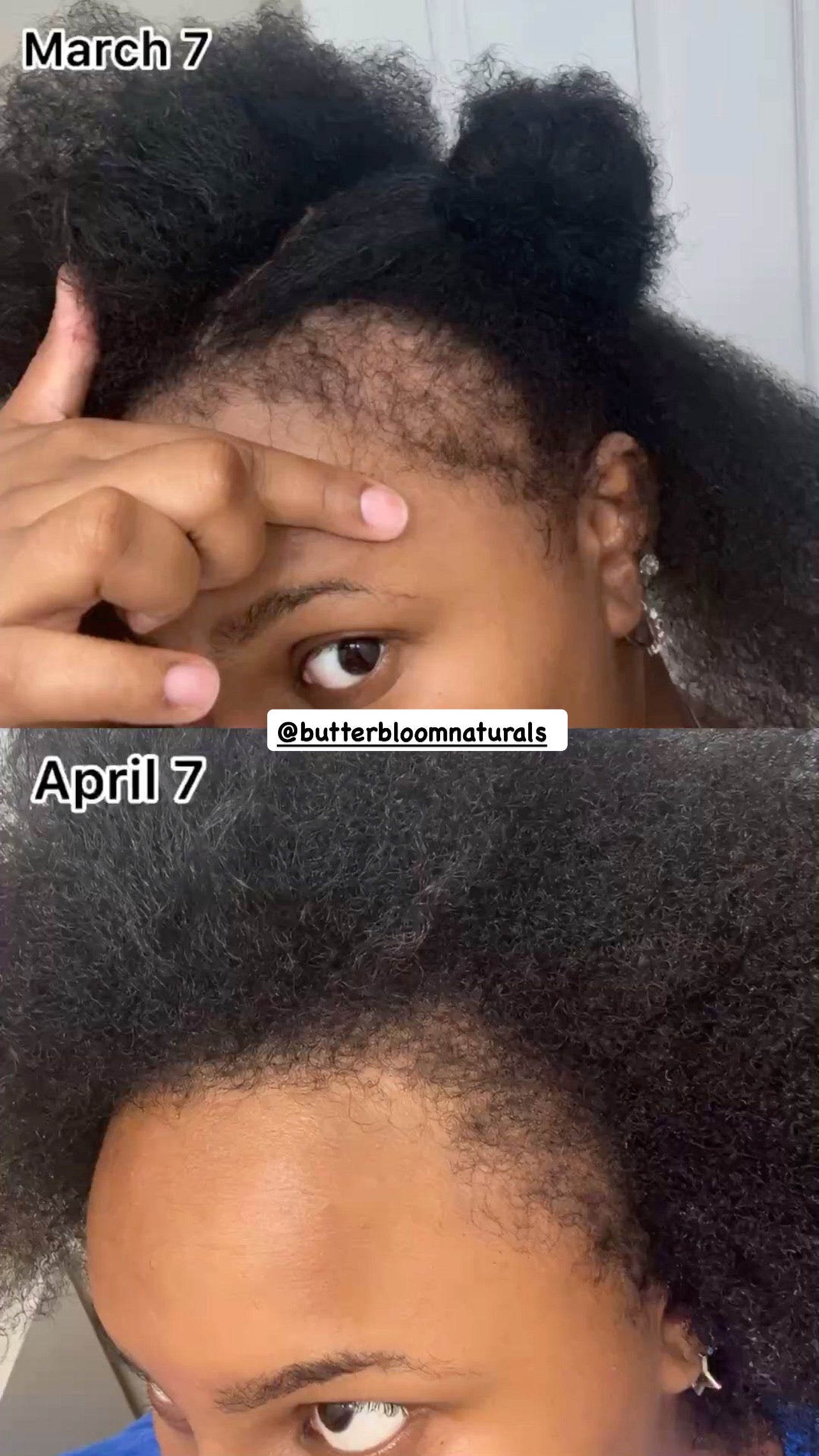 Shea butter, rice water, black soap shampoo, growth oil, and scalp stimulator in a natural hair care bundle by butterbloom.