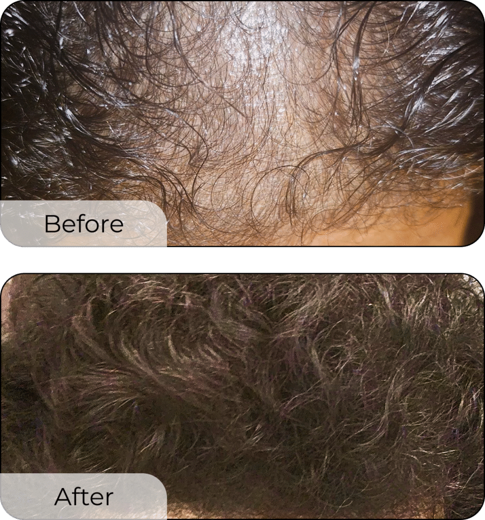 Hair Growth Bundle by butterbloom featuring shea butter, ricewater, black soap shampoo, growth oil, and scalp stimulator.