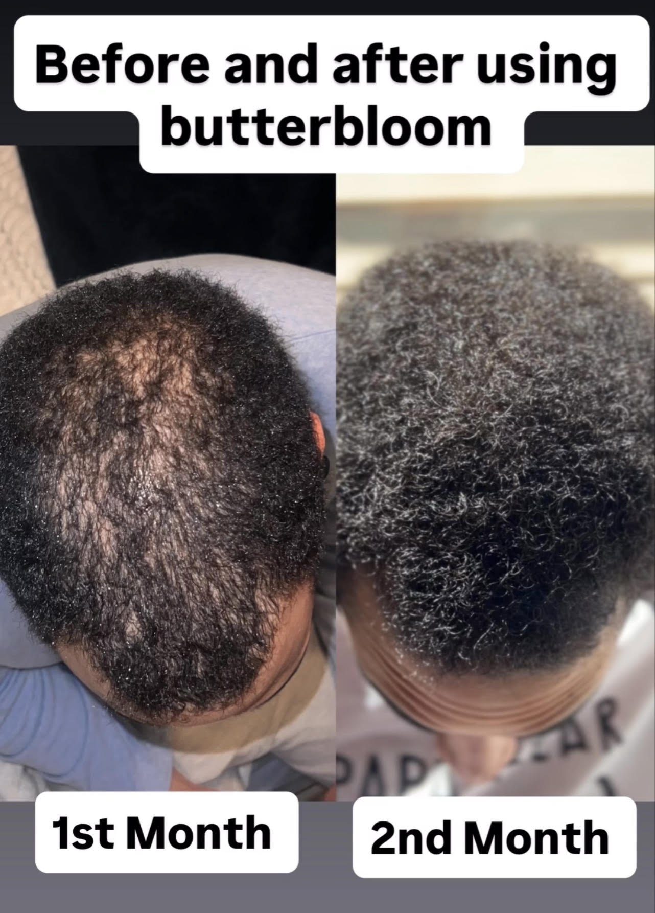Handmade rosemary rice water treatment for hair growth by butterbloom, featuring a small-batch natural haircare product in a clear jar
